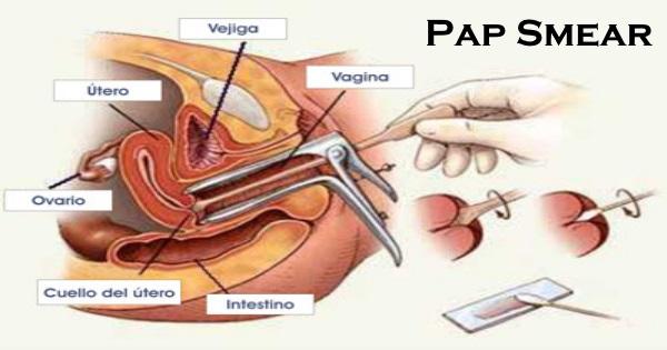 The Pap test (pap smear) is