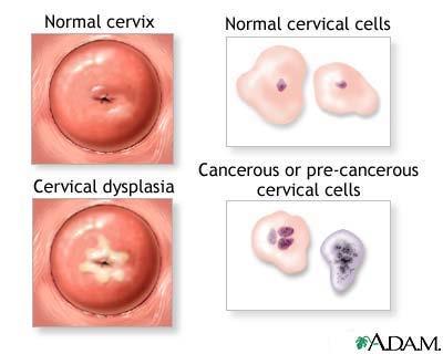 Nearly all cervical cancers are caused by specific types of human papillomavirus (HPV). The use of the Pap test and HPV test provides the most effective means of screening for cervical cancer.