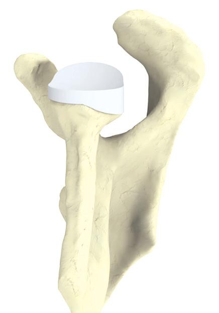 Preservation More Bone, More Support The AEQUALIS PERFORM + system was developed to address posterior glenoid deficiencies, that when treated with traditional implants have demonstrated an increased