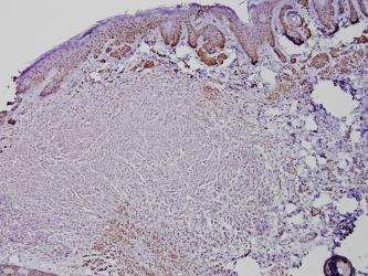 Acute myeloid leukemia B. Cervical cancer C.