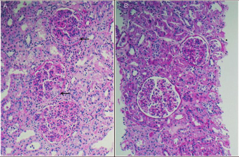 8 Clinical Journal of the American Society of Nephrology Clin J Am Soc Nephrol 5:, 2010 Figure 1. LM findings.