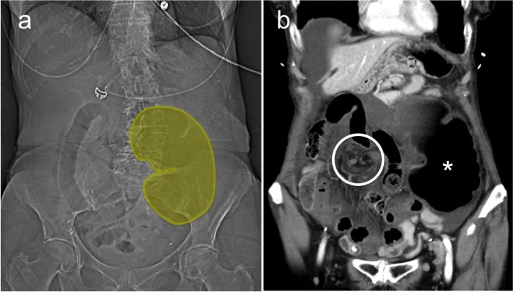 Fig. 8: A 54- year old patient with caecal volvulus shows a kidney bean sign on scout images (a) and a gasemty ascending colon up to the rectum.
