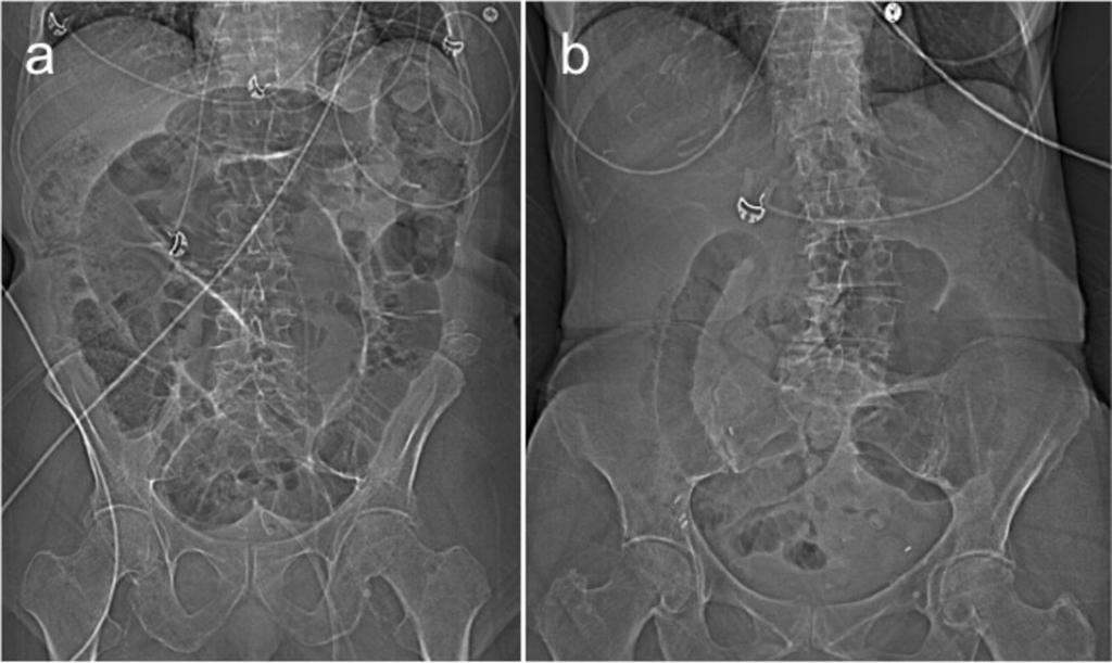 Fig. 9: Comparison of scout images of figure 7 and 8 showing a sigmoid volvulus (a) and a caecal volvulus (b).