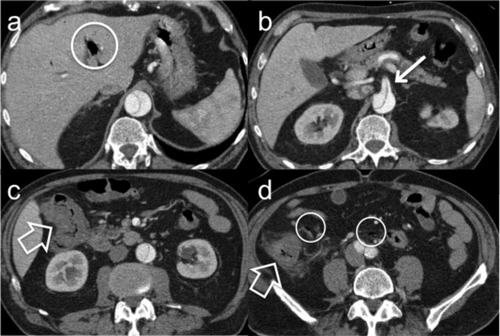 Fig. 11: A 69-year old patient with ischemic colitis (open arrows; c,d) as a complication of prior dissection of the aorta
