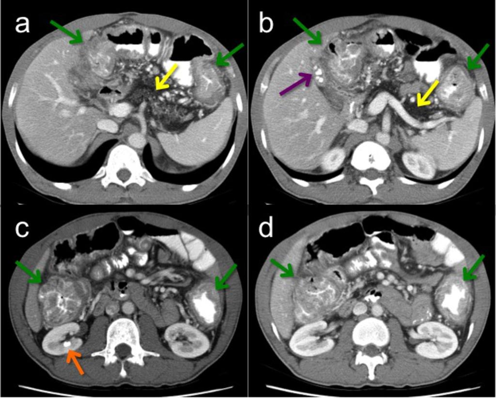 Fig. 12: Pancolitis (green arrows; a-d) due to cystic fibrosis with typical abdominal manifestations: