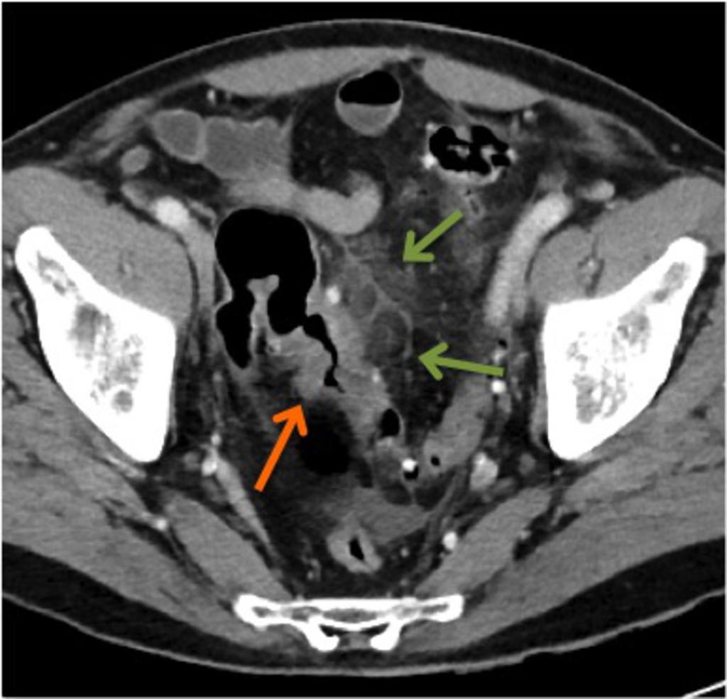 Fig. 1: A 64-year old patient with sigmoid diverticulitis presenting with thickened large