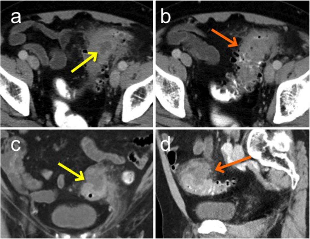 Fig. 2: A 71-year old patient shows an abscess formation (yellow arrows;