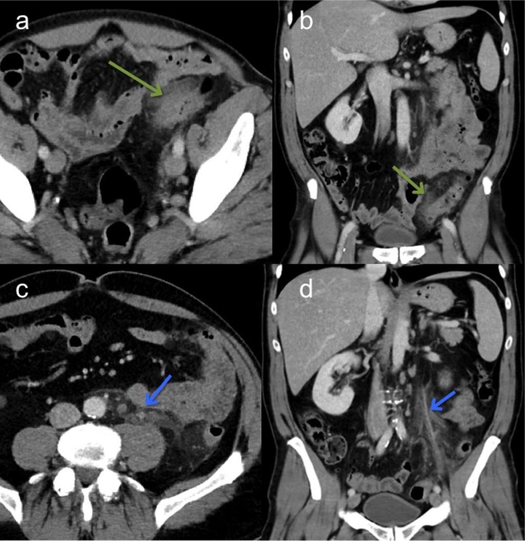 Fig. 3: A 57-year old patient with sigmoid diverticulitis (green arrows; a,b)