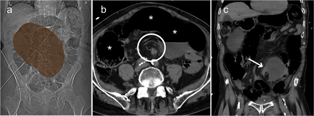 7: A 94-year old patient with sigmoid volvulus already evident on the scout image due to the coffee bean sign (a)