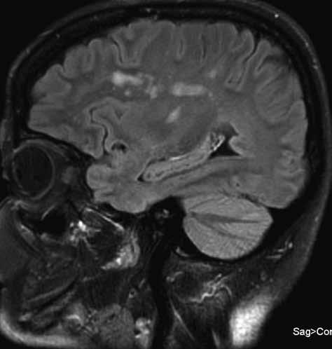 SPOraDic cjd in a PaTienT with relapsing-remitting MUlTiPle SclerOSiS 233 A B FiG. 1.