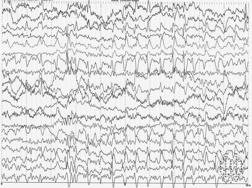 SPOraDic cjd in a PaTienT with relapsing-remitting MUlTiPle SclerOSiS 235 FiG. 3. eeg showing periodic paroxysms of sharp waves and spikes on a slow background corticosteroid therapy.