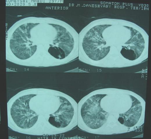 Computer tomography (CT) scan showed ground glass lesions in both lungs with bilateral lung nodules. A cystic lesion was present in the left lower lobe (Figure 2).