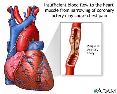 your heart muscle doesn't get enough oxygen-rich blood.