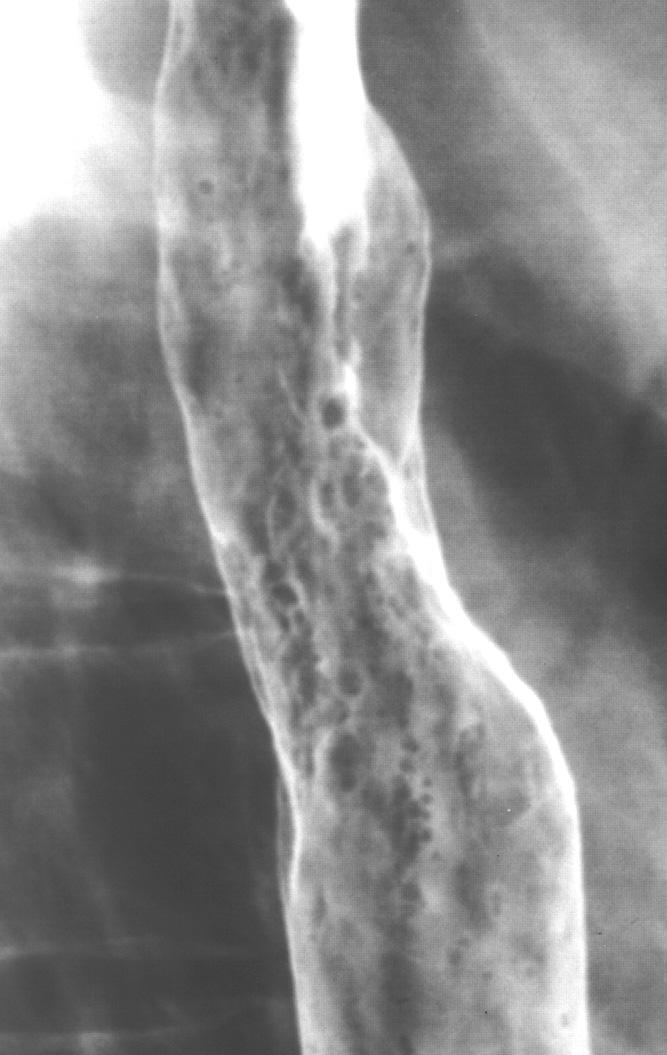 63 66 Eosinophilic Esophagitis Eosinophilic esophagitis usually occurs in young men with longstanding dysphagia and occasional superimposed food impactions.