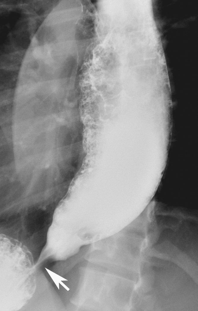 20,21 This radiation damage can result in severe pharyngeal dysfunction and poor epiglottic tilt with tracheal aspiration (Figure 3).