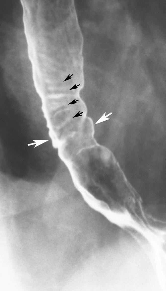 January 2008 BARIUM ESOPHAGOGRAPHY 17 Figure 11. Scarring from reflux esophagitis.