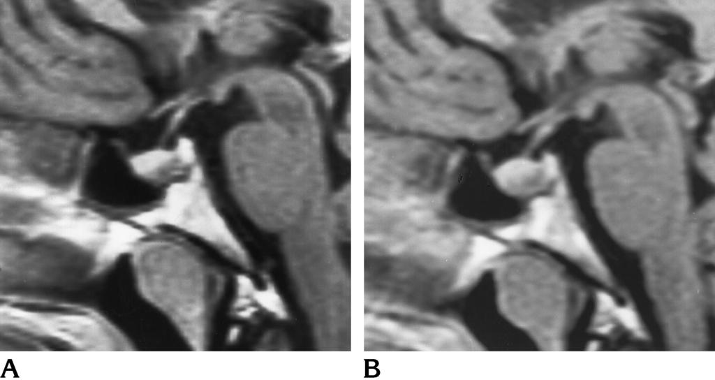 770 LUNDIN AJNR: 18, April 1997 Fig 4. Patient 7. Contrast-enhanced sagittal T1- weighted images (520/20).