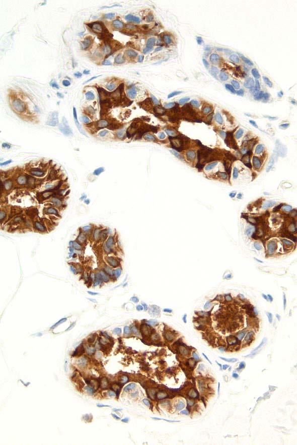 Mammaglobin Mammary-specific member of the uteroglobin family Adenocarcinomas Breast +/ Sweat