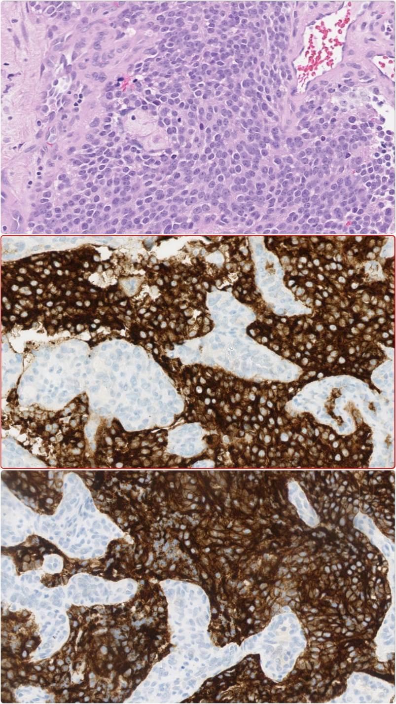 Ep-CAM Often upgraded in malignancies +(-) Adenocarcinomas (of most types) Neuroendocrine neoplasms +/- Germinal cell tumours