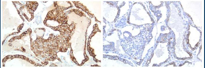 26 Papillary thyroid carcinoma CK19: clone