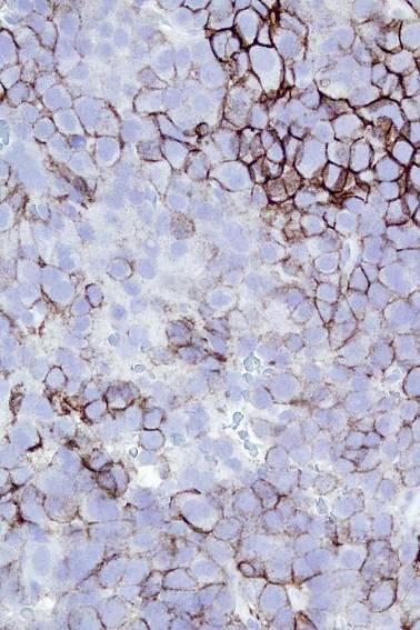 Ep-CAM -/+ Lobular breast carcinoma Hepatocellular carcinoma Squamous cell carcinoma Renal cell carcinoma