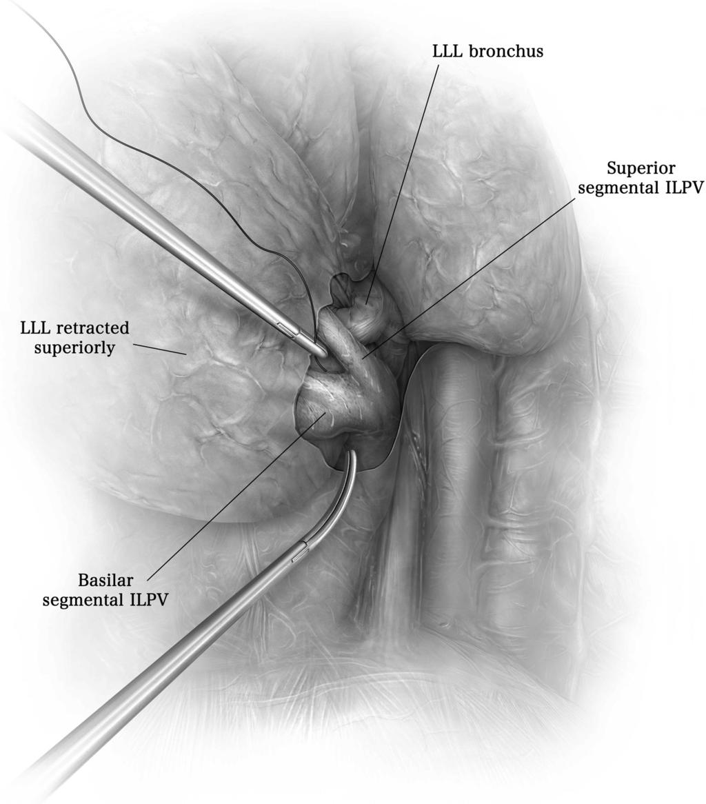 120 J.R. Sonett Left Lower Lobe Basilar Segmentectomy Figure 12 The access incisions and position of the patient are the same as for the left lower lobe superior segment.