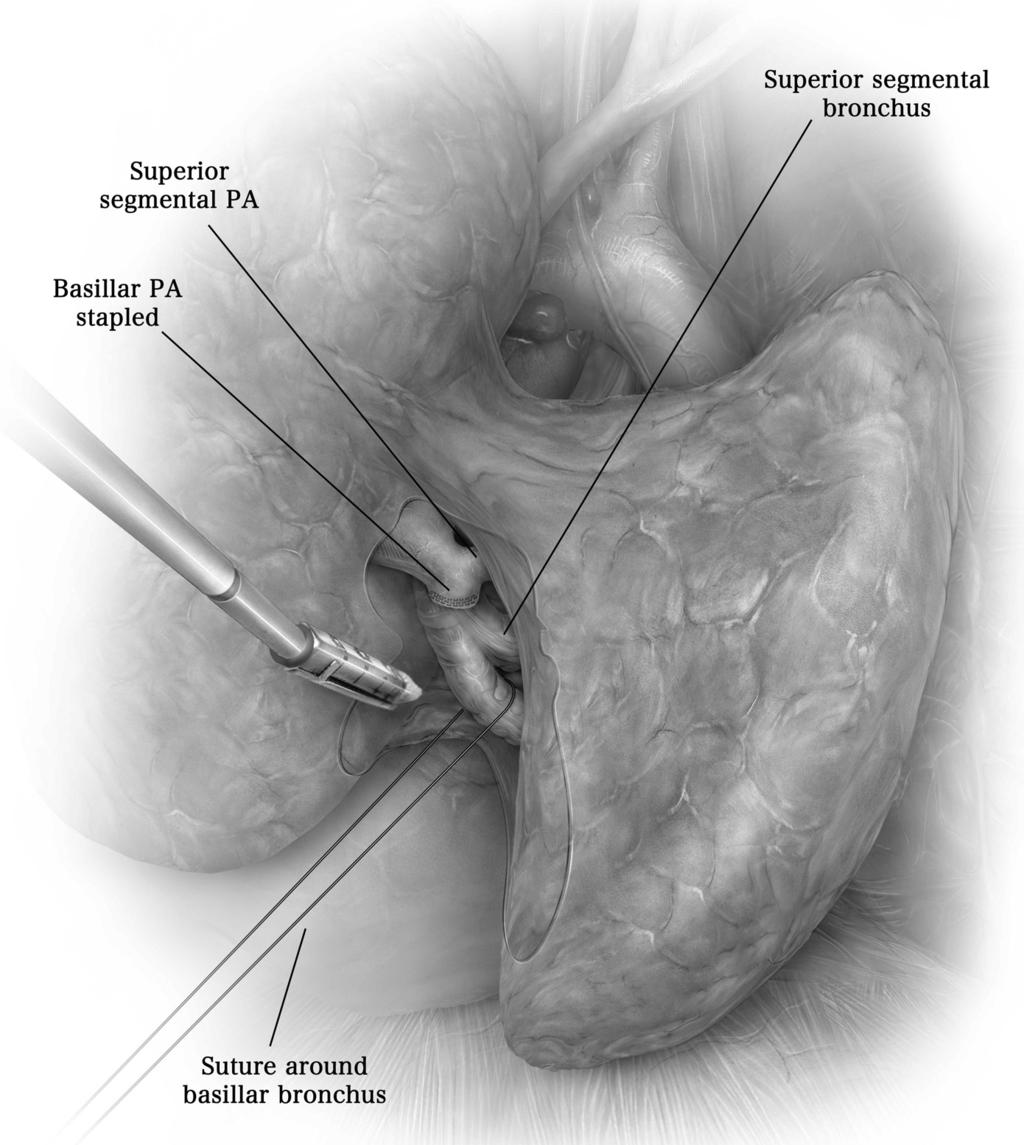 Minimally invasive segmentectomy 123 Figure 15 The pulmonary artery to the basilar segments are stapled, which exposes the complete bronchial anatomy.
