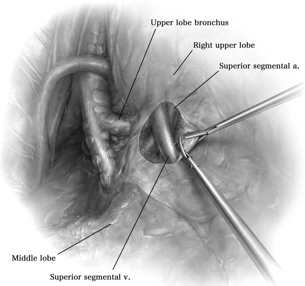 Minimally invasive segmentectomy 111 Figure 3 The vein is dissected in the fissure and prepared for isolation.
