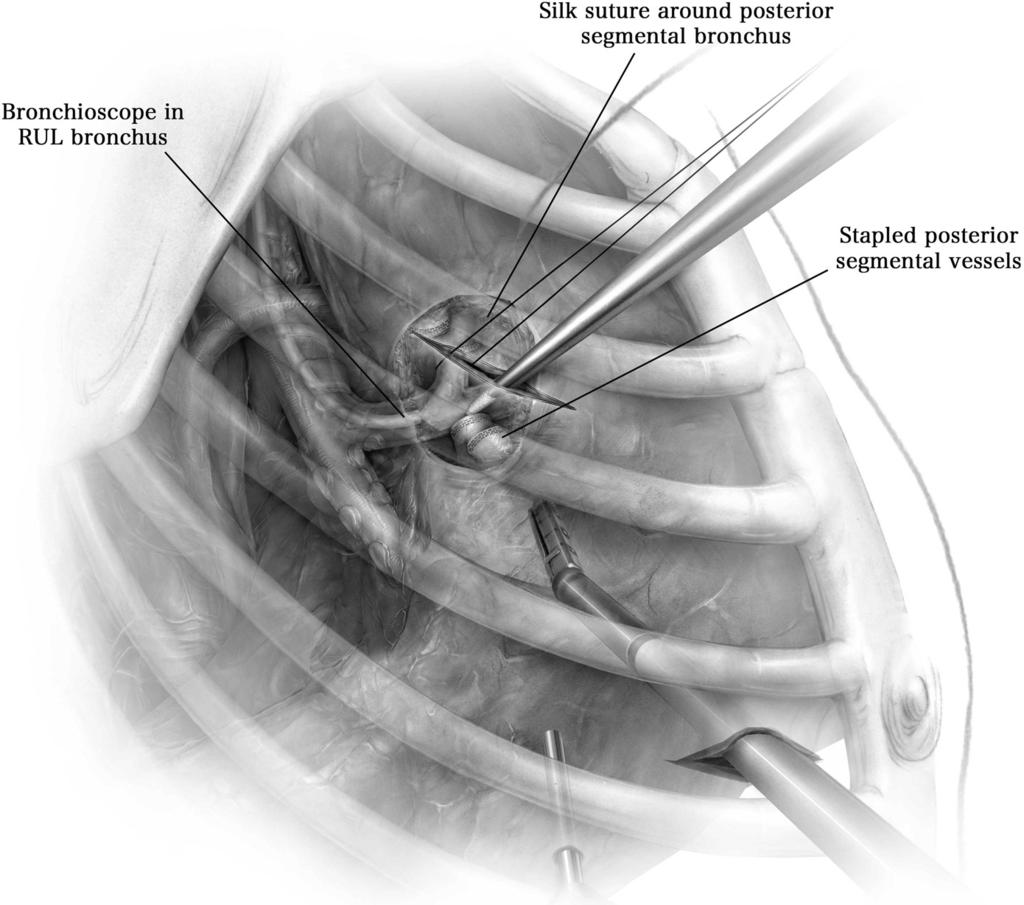 Minimally invasive segmentectomy 113 Figure 5 After transection of the artery, the segmental bronchus and upper lobe bronchus proper are visualized.