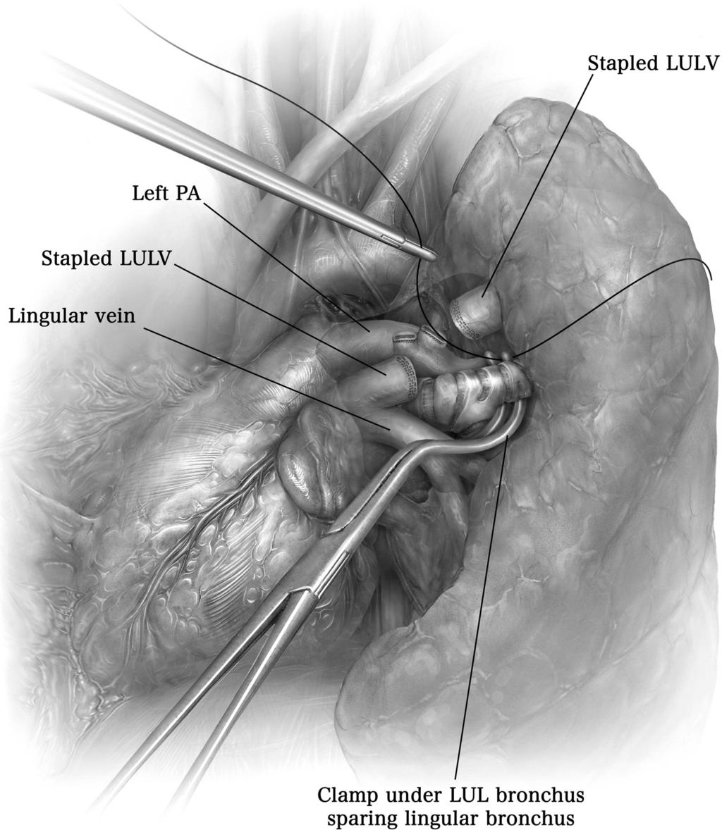Minimally invasive segmentectomy 115 Figure 7 After the superior pulmonary vein is stapled, dissection of the main pulmonary artery usually reveals 2 to 3 anterior apical branches of the left upper