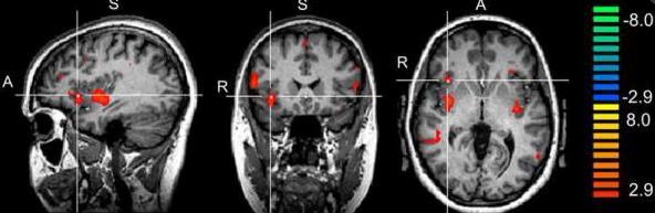 Brain Reactivity to Smoking Cues Predicts Treatment Outcomes Subjects who