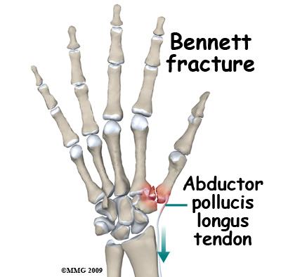 Your surgeon will pay particular attention to fractures that involve the joint between the trapezium and the base of the thumb metacarpal.