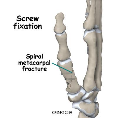 X-rays will be taken frequently to make sure that the fracture remains in alignment.