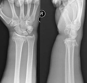 Distal Radius Fracture Mechanism of Injury FOOSH with hyperextension of the wrist Exam Pain, swelling, ecchymosis, silver fork deformity Check median
