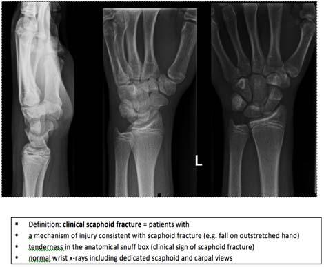 Distal Radius Fracture Treatment Nonsurgical (Stable & extrarticular Nondisplaced extraarticular fractures are treated with a long arm cast for 4-6 weeks Indications for Ortho Displaced Comminuted