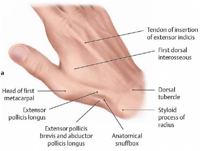 Scaphoid Fracture Most commonly injured carpal bone Mechanism of injury FOOSH with wrist