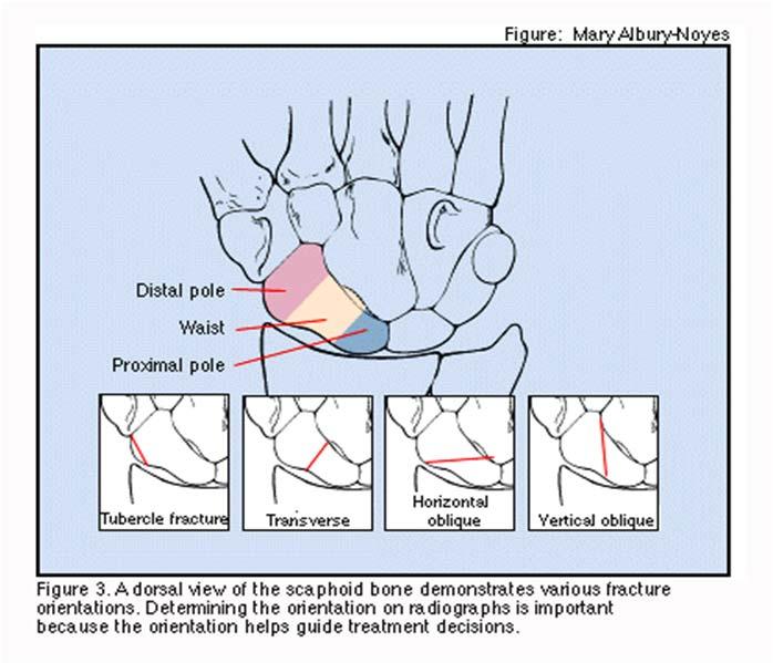 Scaphoid Fracture Vascular anatomy Blood supply retrograde Risk of AVN at proximal