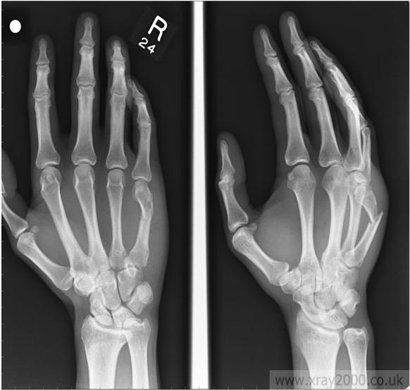 Metacarpal Shaft Fractures Transverse Unstable fractures Tend to angulate with the apex dorsal; due to volar pull of interossei Imaging AP, lateral and oblique of hand Treatment Reduction if : Any
