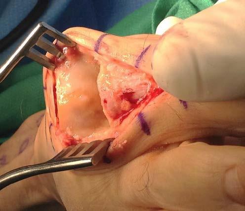 the metatarsal head to penetrate the subchondral bone to create a bleeding bony surface A 3.5cm x 3.