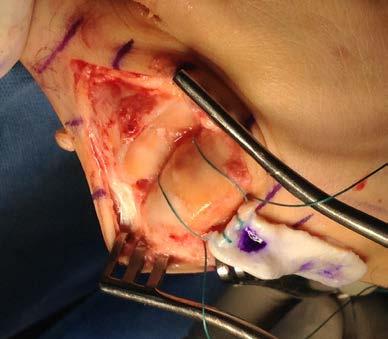 reticular layer of the graft is placed against the metatarsal