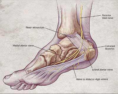 Surgical treatment of plantar fasciitis Open fasciectomy