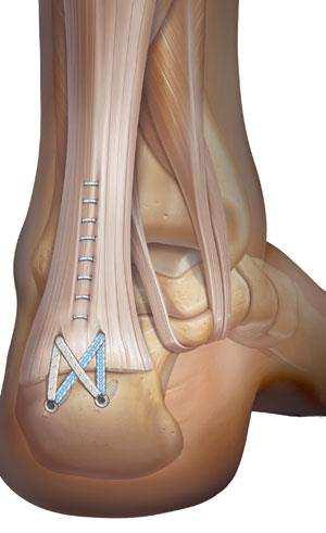 Posterior heel spur Posterior approach Achilles split Excision bony
