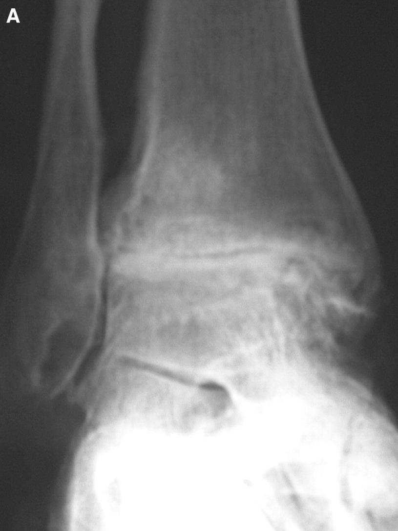 Ankle arthritis Open fusion