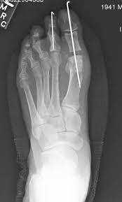 Hallux Rigidus Keller Procedure (resection arthroplasty) indications elderly, low demand patients with significant joint degeneraion and loss of motion technique involves
