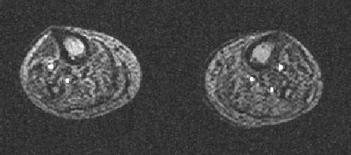 Axial 2D TOF Image: Our Patient Axial 2D TOF slice from mid-calf Anterior Tibial Peroneal