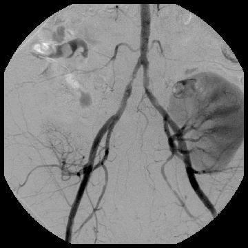 Our Patient: Contrast Angiography failed renal transplant A little later: Now the remnants of the vascular supply to his first, failed renal transplant also becomes visible, off the right internal