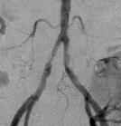 with an endovascular stent.