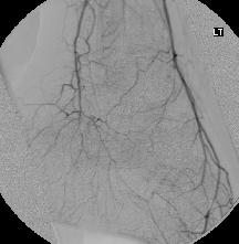 Contrast Arteriography: The Gold Standard Superficial femoral artery Profunda Posterior tibial