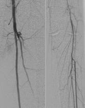 Iodinated contrast - potentially nephrotoxic (as high as 11% incidence of acute renal failure