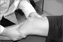 contact injury o Plant and cut o Landing on a straight leg o One-step deceleration Pop Effusion,